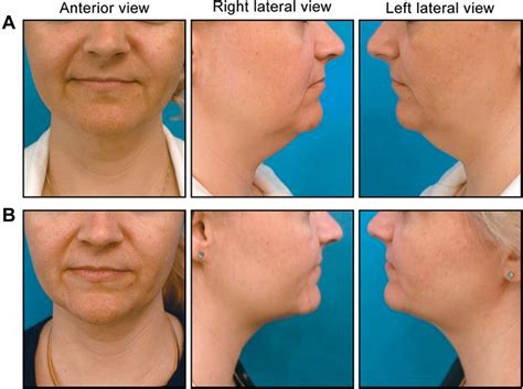 Nonsurgical Approaches To The Aging Neck Advances In Cosmetic Surgery