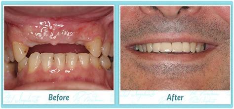 Anne's dental implant before and after story. How Long Can I Wear An Implant Temporary Crown | FDG Teeth ...
