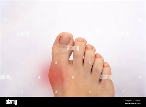 Foot Disease Rheumatism And Gout Painful Gout Inflammation On Big Toe