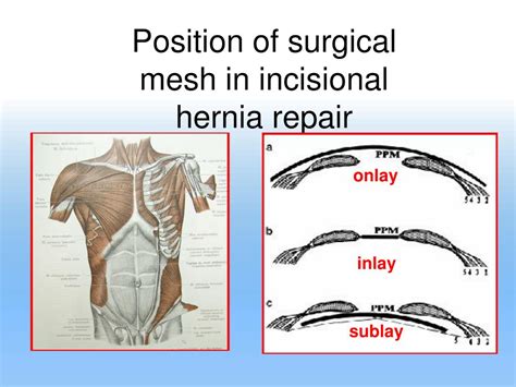 Ppt Abdominal Hernias And Surgical Meshes Powerpoint Presentation