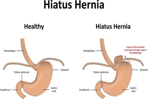 Lesser Known Facts About Hiatal Hernia Dfw Bariatrics And General