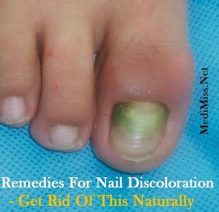 Walking bare foot on the honey: Home Remedies For Nail Discoloration - Get Rid Of This ...