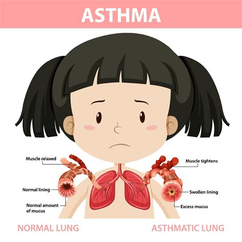 Lung Alveoli Normal And Asthma Cartoon Vector Cartoondealer Com My Xxx Hot Girl