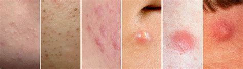 Different Types Of Spots And How To Treat Acne Dr Fox