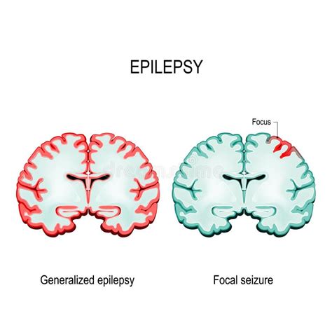 Epilepsie Eeg Des Gesunden Gehirns Und Des Epileptischen Anfalls Vektor