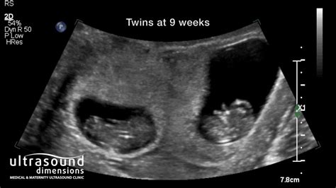 Scan Of The Week Twins At 9 Weeks Gestation Youtube