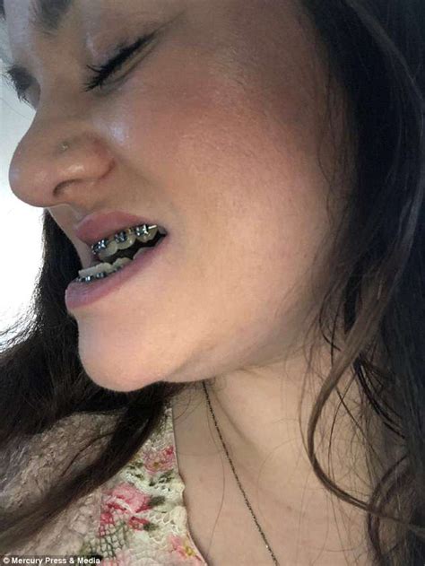I have an underbite and for some reasons i can't fix it with a surgery so i am wondering if a mustache or a beard would cover/hide it? Holly Everson-Bullock has jaw realigned after underbite ...