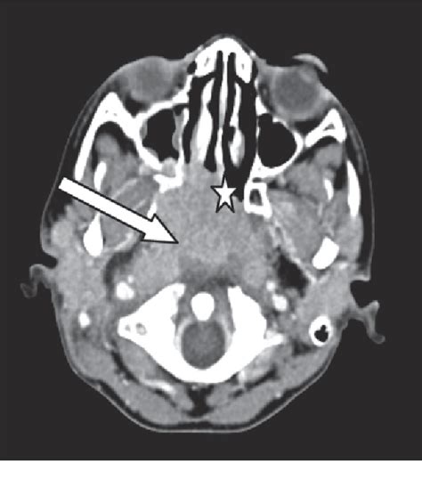 Figure 2 From A Child With Epistaxis Reduced Hearing And Cervical