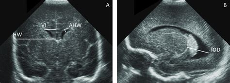 Fetal Lateral Ventricle Measurement Ultrasound