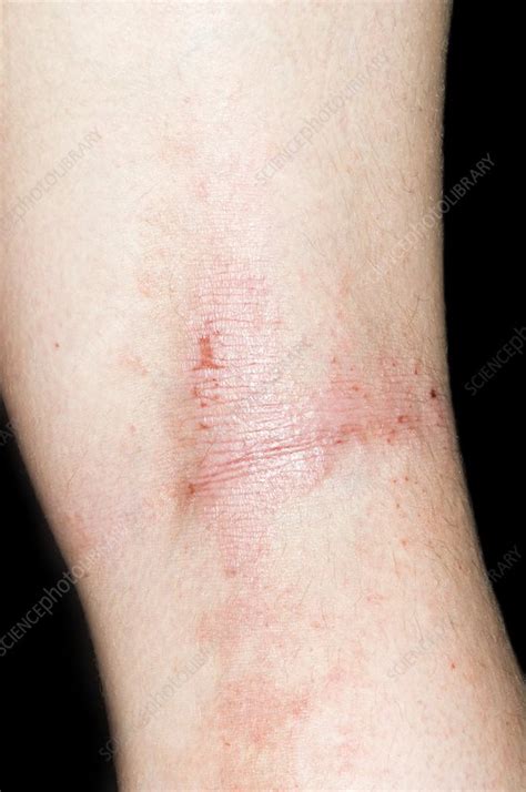 Atopic Eczema Stock Image C0016617 Science Photo Library