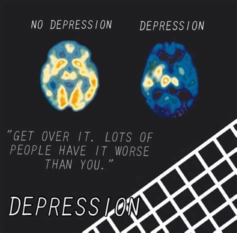 Depression Brain Scan