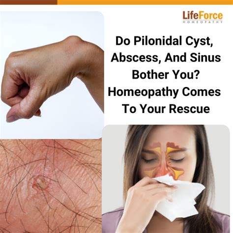 Do Pilonidal Cyst Abscess And Sinus Bother You