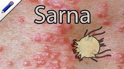 Como é Sarna Humana Fotos
