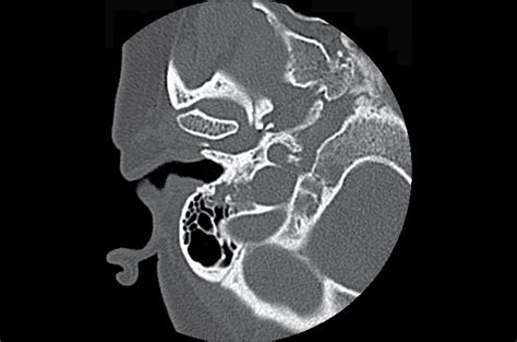 Radiology Quiz Case 1 Radiology Jama Otolaryngologyhead And Neck Surgery Jama Network