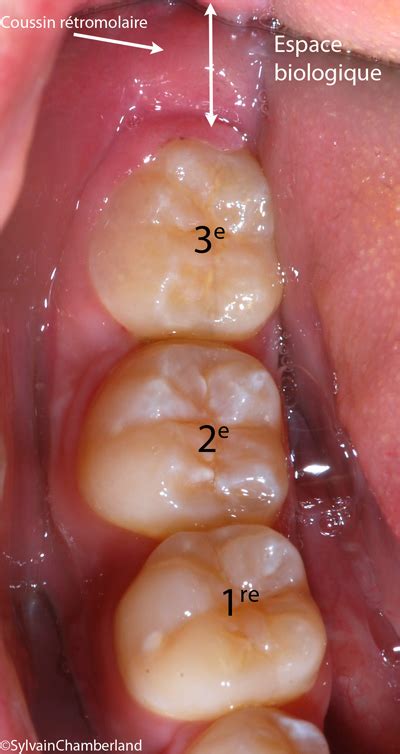 Gum Pain Behind Last Molar No Wisdom Teeth Teethwalls