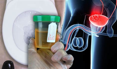 Bladder Cancer Symptoms Urine Signs When Using The Toilet Uk