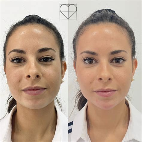 Contouring Facial Clínicas Love