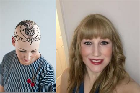 Alopecia Women On What Its Like To Have Hair Loss In Your Twenties