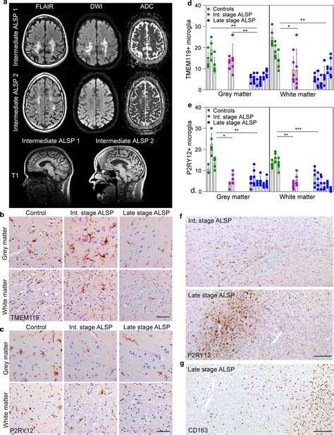 Alsp Patients Show An Overall Loss Of Homeostatic Microglia And
