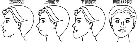 顎変形症の外科的矯正治療 | 宮崎大学医学部 感覚運動医学講座 ...