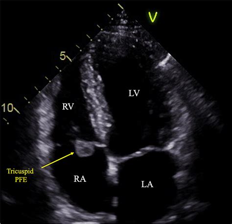 Cureus Discovery Of Tricuspid Fibroelastoma On Echocardiography