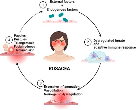 Rosacea Topical Treatment And Care From Traditional To New Drug