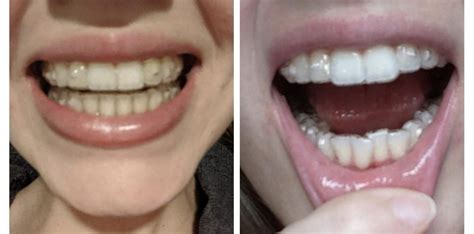 Before And After 6 Months Of Invisalign Lite Rinvisalign