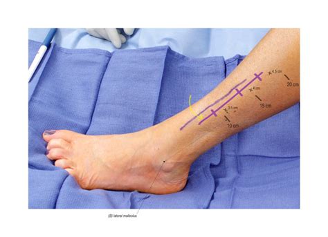Superficial Peroneal Nerve Release In The Lower Leg Surgical