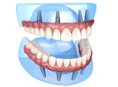How much do dental implants cost per tooth and for full mouth implants dentures. How much do all-on-4 dental implants cost? | Lewis Dentistry