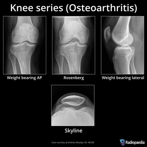 Arthritis Of The Knee Aging The Healthy Way