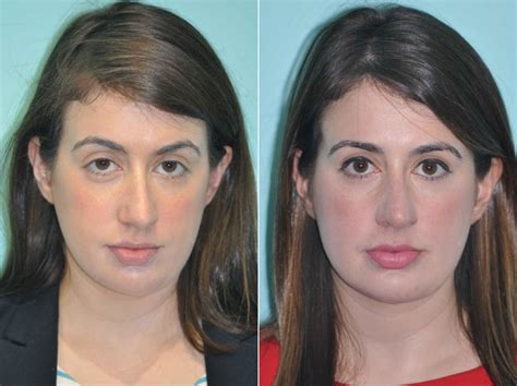 Neck Liposuction Photos Chevy Chase Md Patient 12809