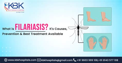 What Is Filariasis Its Causes Prevention And Best Treatment