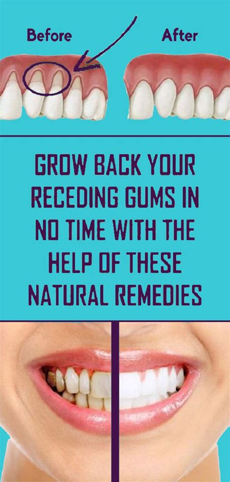 How to keep gums from receding. Treat Receding Gums Naturally Using These Methods - Home ...