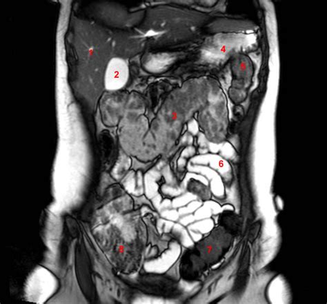 MRI Abdomen Coronal Flashcards By ProProfs