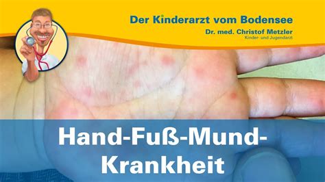 Hand Fuß Mund Krankheit Der Kinderarzt Vom Bodensee Youtube