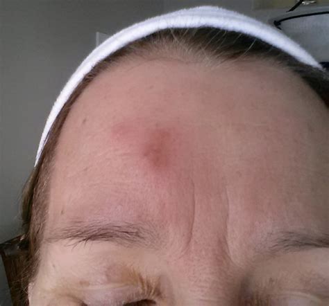 On Jan 29th I Noticed A Tiny Red Mark On My Forehead Didnt