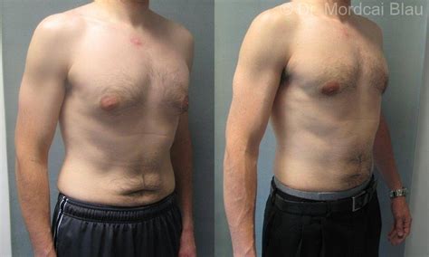 As much as i hyped it up and avoided going to the gynecologist because of how horrible and awkward i imagined it would be, the appointment really wasn't bad even if things like cervical cancer and breast cancer are rare in teens and young women, regular visits to the gyno are an important preventative. Post Weight Loss Gynecomastia Surgery - Before and After ...