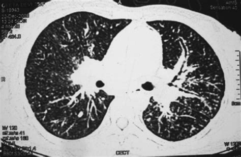Ct Of The Chest Showing Miliary Sarcoidosis While The Open I