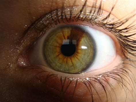 An Example Of Sectoral Heterochromia A Green Eye With A Brown Section