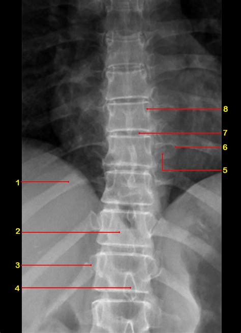 Lumbar Spine Radiographic Anatomy Wikiradiography Hot Sex Picture