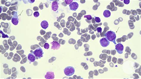 T Cell Acute Lymphoblastic Leukemia