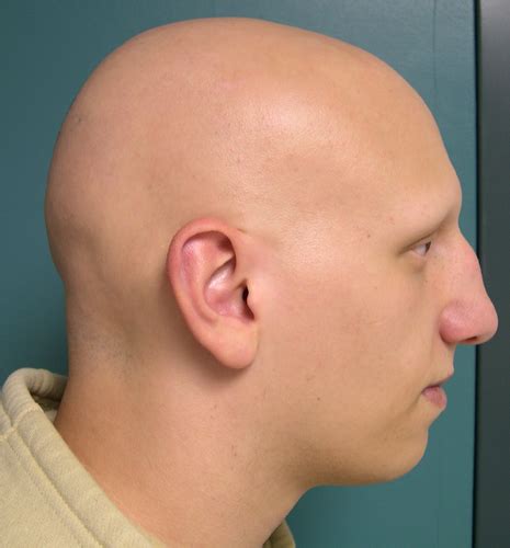 Baldness typically refers to excessive hair loss from your scalp. Alopecia Totalis - Symptoms, Causes and Treatment