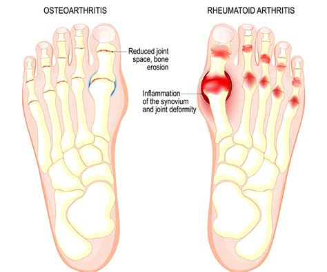 Treatment For Big Toe Joint Pain Foot Arthritis Moore Foot And Ankle