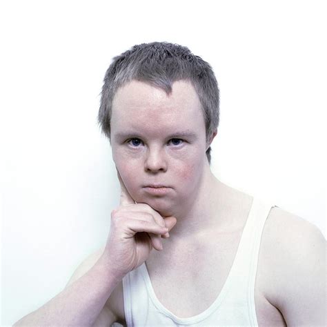 Face Of A Man With Down S Syndrome Photograph By Larry Dunstan Science Photo Library Pixels