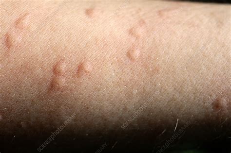 Rash From Fire Ant Stings Stock Image M3200399 Science Photo Library
