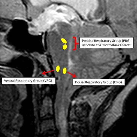 Sagittal T Weighted Mri Showing A Case Of Tonsillar Herniation