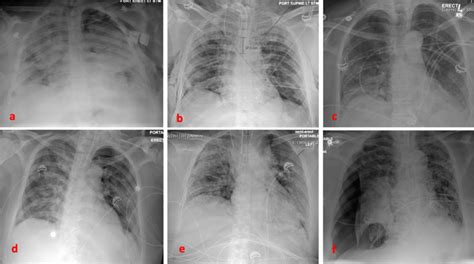 Chest Radiograph For Each Patient Revealing The Pneumothorax From Top