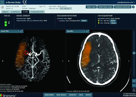 Artificial Intelligence And Acute Stroke Imaging American Journal Of