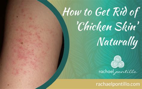 How To Get Rid Of Chicken Skin Aka Keratosis Pilaris Naturally