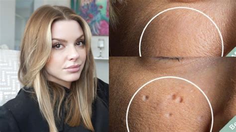 Esthetician Discusses How To Eliminate Pitted Acne Scars Youtube